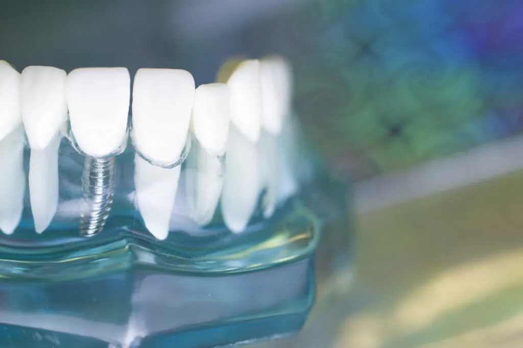 上部構造(人工歯)装着